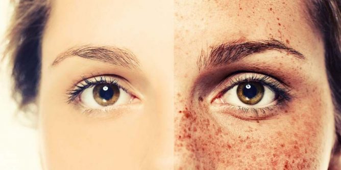 removing face freckles